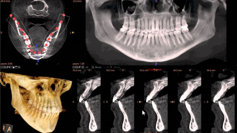 CBCT